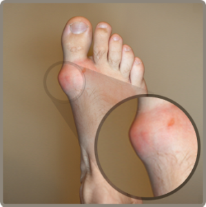 Gout Remedy Report – Naturally Treat Gout with 5 Free Gout Tips 